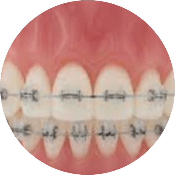 Self-Ligating Braces
