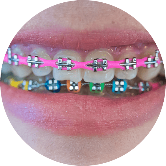 Coloured Braces