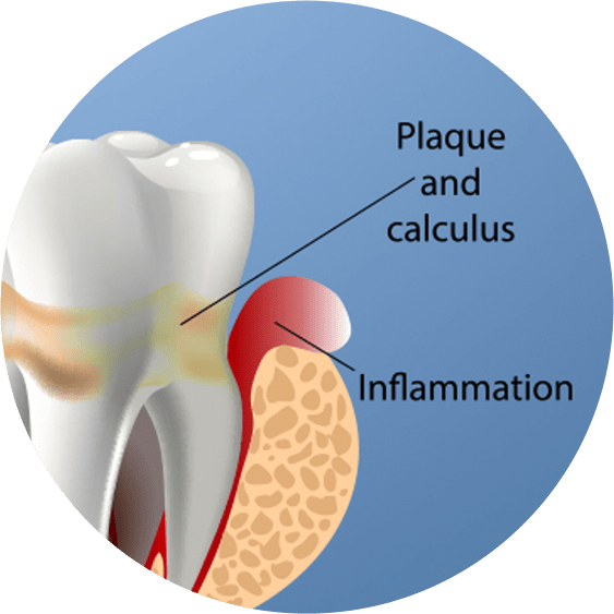 WHAT IS RECEDING GUMS?